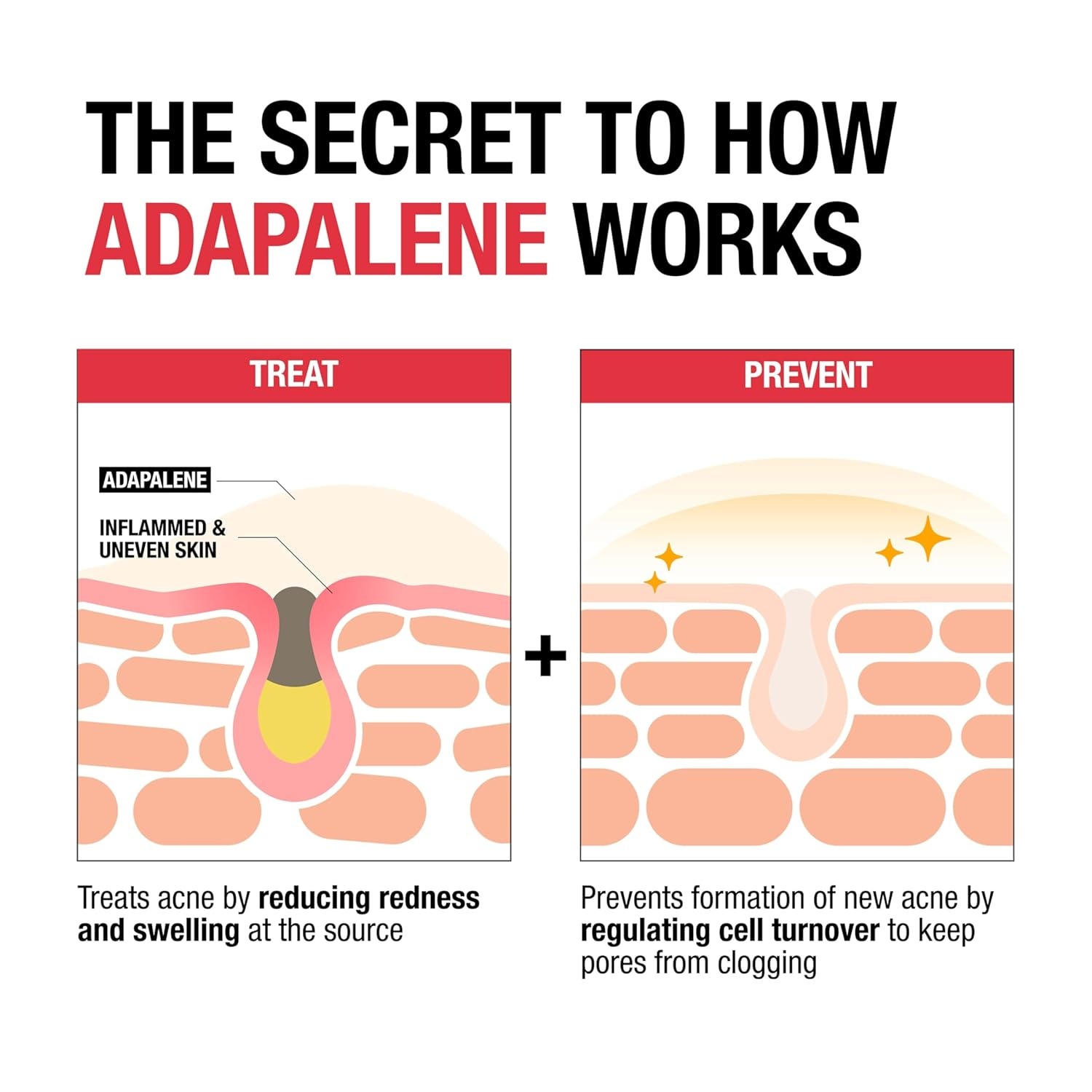 image:imageNeutrogena 01 Adapalene Gel Acne Treatment Topical for Acne Adapalene Medication for Blemishes Once Daily Topical Retinoid to Prevent Breakouts Oil amp FragranceFree 16 oz
