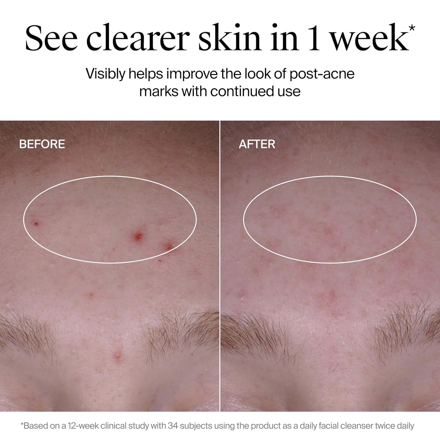 image:imageNeutrogena Evenly Clear Acne Cleanser with 2 Salicylic Acid amp 2 PHA Exfoliant Gentle Foaming Face Wash Clears Clogged Pores amp Blackheads While Visibly Fading Look of PostAcne Marks 91 fl oz
