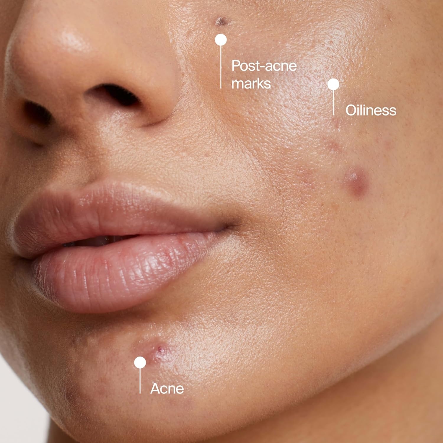 image:imageNeutrogena Evenly Clear Acne Cleansing Face Mask with 35 Benzoyl Peroxide Treats Breakouts amp Bentonite Clay Purifying Clay Mask Absorbs Oil to Visibly Improve the look of Skin 42 fl oz