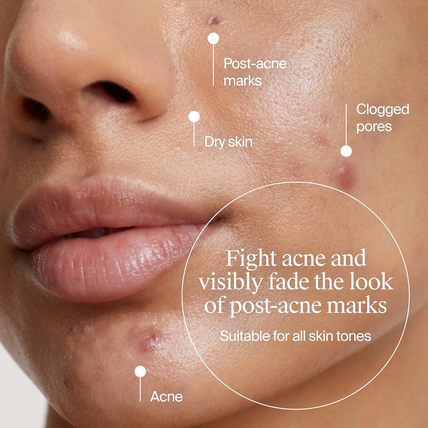 image:imageNeutrogena Evenly Clear Acne Gel Moisturizer with Salicylic Acid amp NAcetyl Glucosamine Lightweight NonGreasy Face Moisturizer Helps Treat Breakouts amp Visibly Fade the look of PostAcne 17 fl oz
