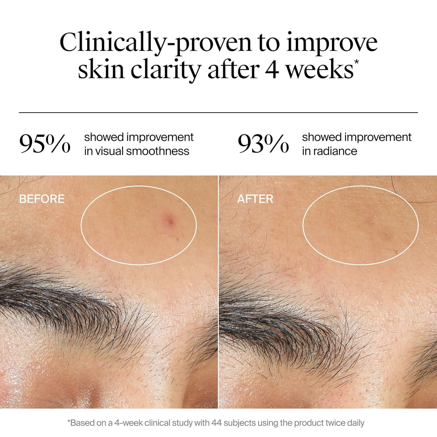image:imageNeutrogena Evenly Clear Acne Gel Moisturizer with Salicylic Acid amp NAcetyl Glucosamine Lightweight NonGreasy Face Moisturizer Helps Treat Breakouts amp Visibly Fade the look of PostAcne 17 fl oz