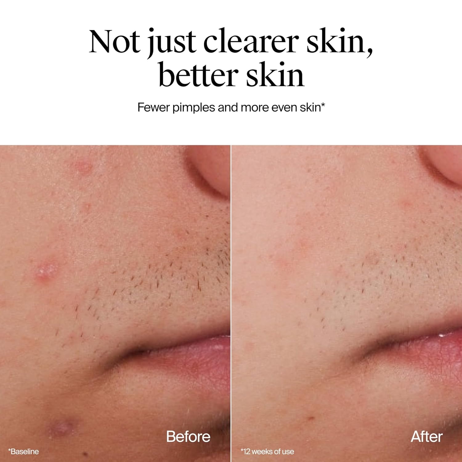 image:imageNeutrogena OilFree Acne Face Wash Fragrance Free Sensitive Skin Facial Cleanser with 2 Salicylic Acid Acne Treatment for Face 91 Fl Oz91 Fl Oz Pack of 2
