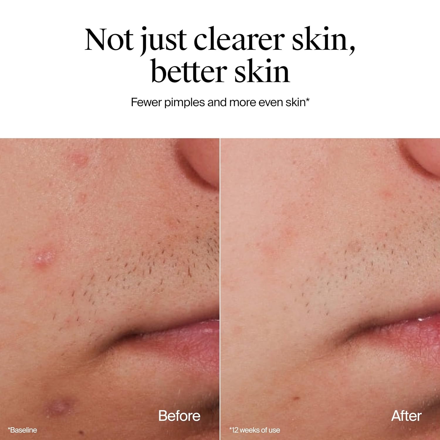 image:imageNeutrogena OilFree Acne Face Wash Fragrance Free Sensitive Skin Facial Cleanser with 2 Salicylic Acid Acne Treatment for Face 91 Fl Oz91 Fl Oz Pack of 1