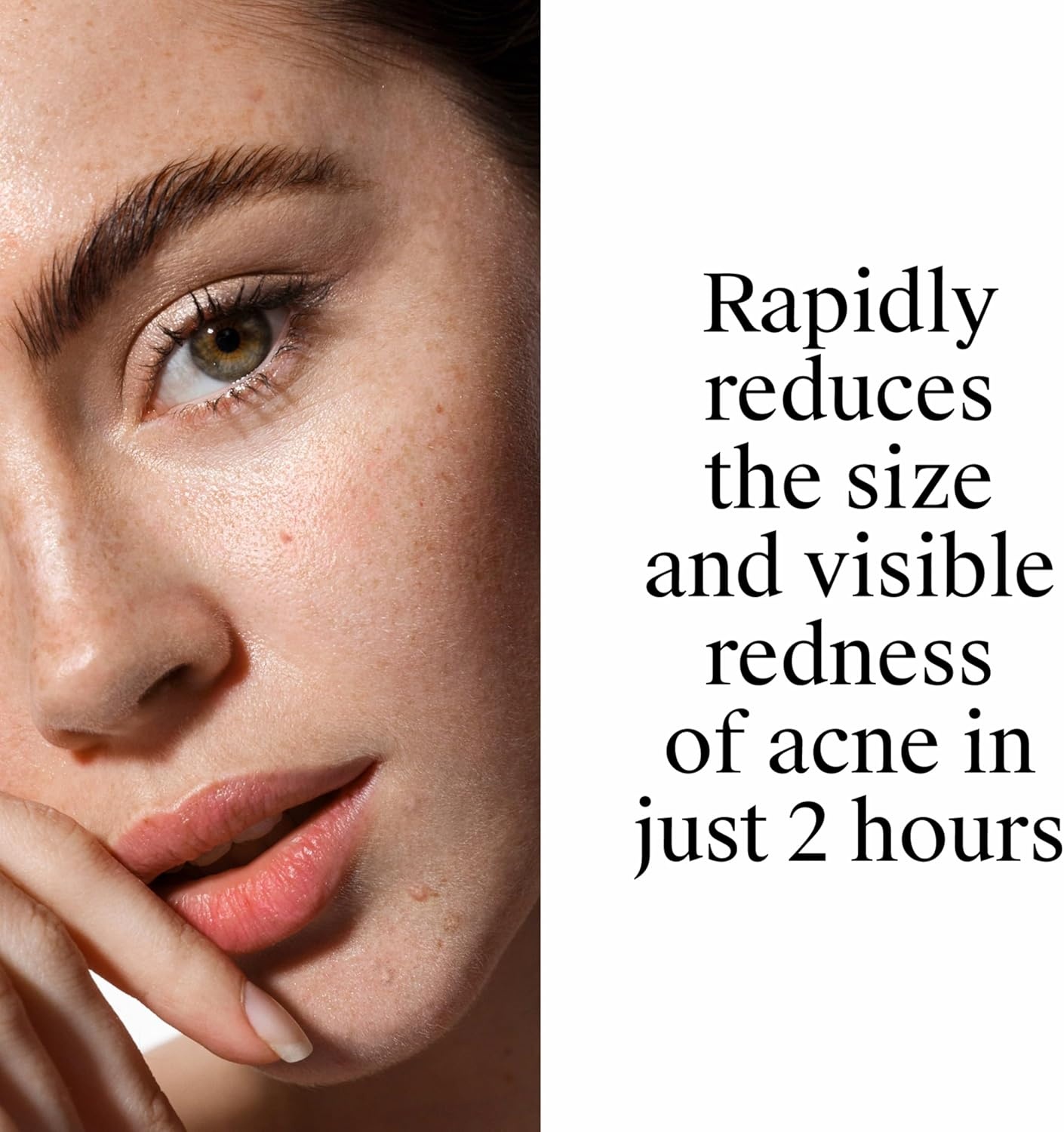 image:imageNeutrogena Rapid Clear Stubborn Acne Spot Treatment Gel Maximum Strength 10 Benzoyl Peroxide Treatment Medication for Acne Prone Skin Pimple Cream Reduces Size amp Redness 1 oz