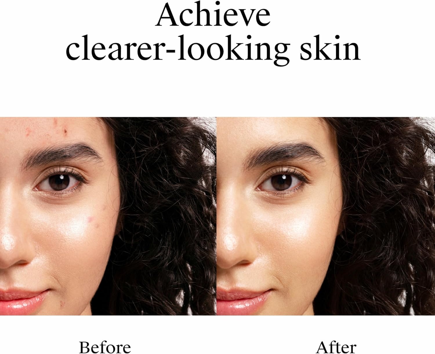 image:imageNeutrogena Rapid Clear Stubborn Acne Spot Treatment Gel Maximum Strength 10 Benzoyl Peroxide Treatment Medication for Acne Prone Skin Pimple Cream Reduces Size amp Redness 1 oz