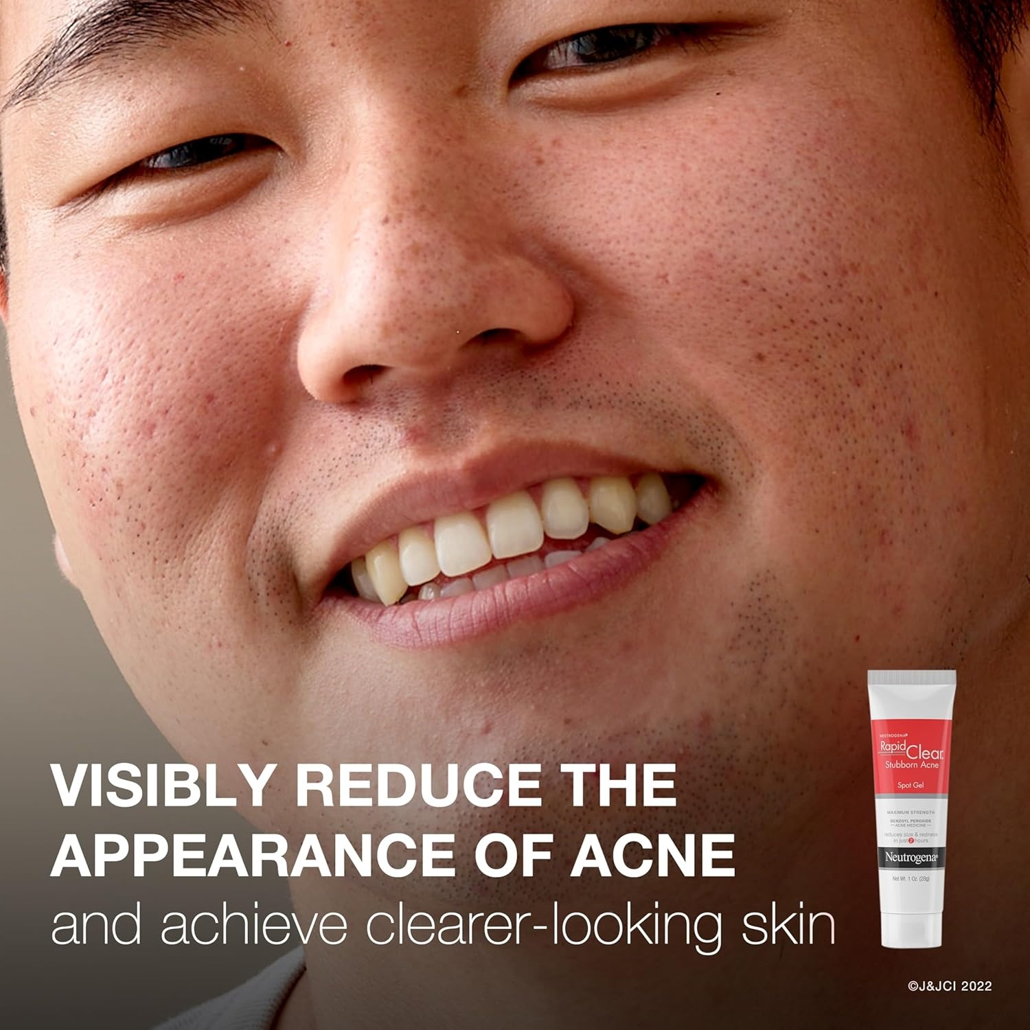image:imageNeutrogena Rapid Clear Stubborn Acne Spot Treatment Gel with Maximum Strength 10 Benzoyl Peroxide Acne Treatment Medication Pimple Cream for Acne Prone Skin Care 1 oz 2 Pack