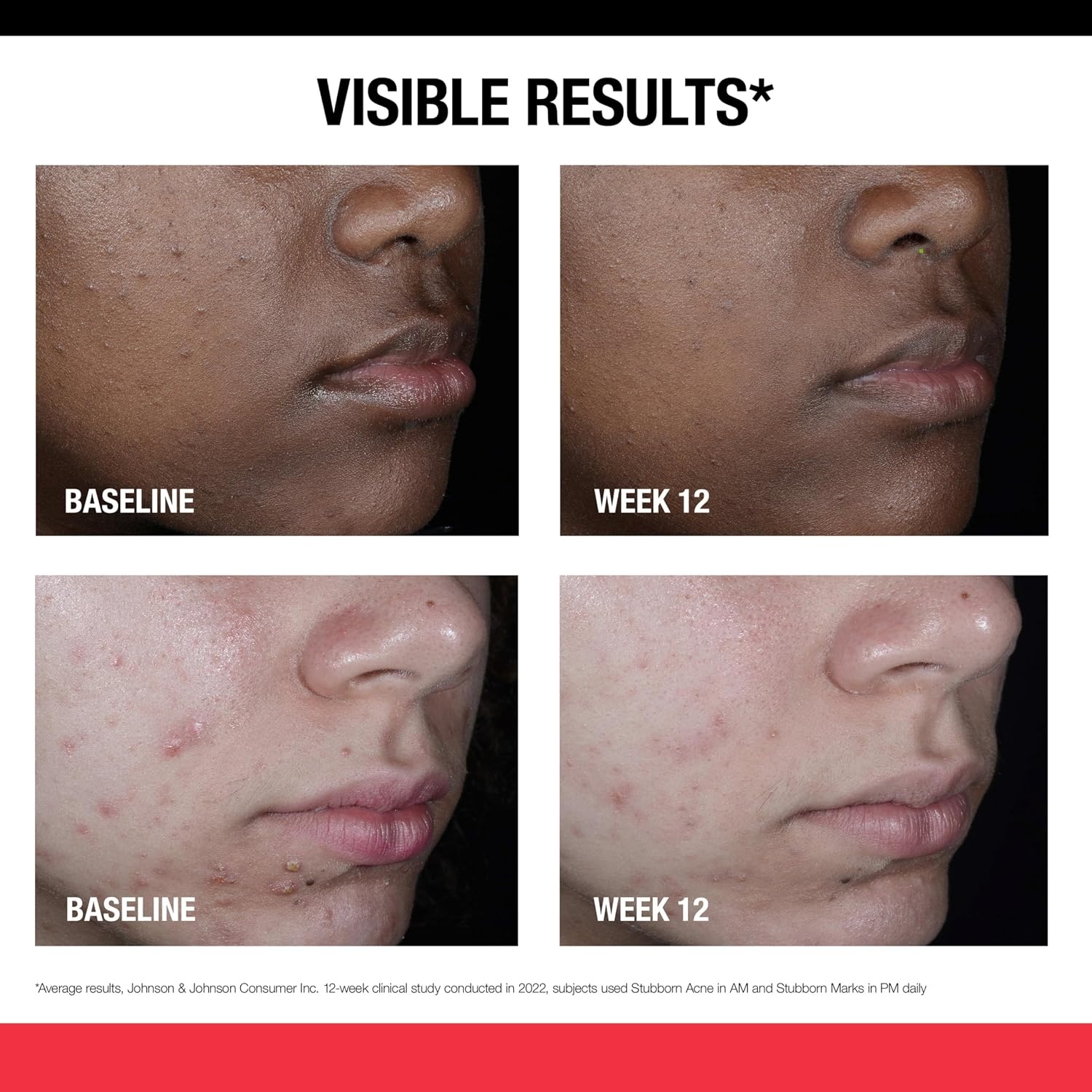 image:imageNeutrogena Retinol SA Stubborn Marks PM Treatment FaceExfoliating Treatment to Help Reverse the Look of PostAcne Marks amp Uneven Skin Tone NonComedogenic PM Treatment unscented 10 Fl Oz
