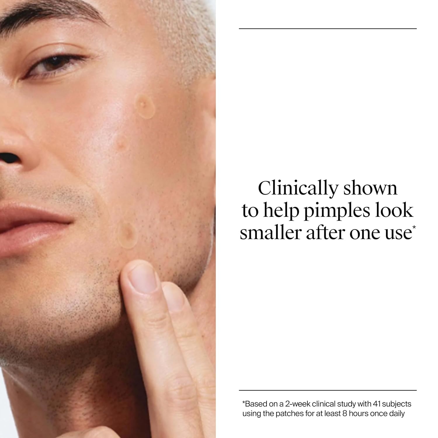 image:imageNeutrogena Stubborn Acne Patches Hydrocolloid Absorbs Impurities UltraThin Pimple Patches Work Overnight 24 ct